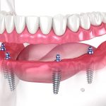 How Dental Implants Influence Bacterial Balance and Create a Healthier Oral Microbiome